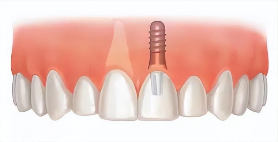 鍙ｈ厰涓撳,鍙ｈ厰绉戣鏈変竴棰楀潖鐗欒淇ˉ