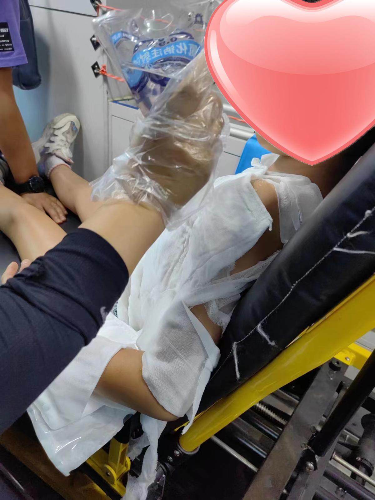 孩子烫伤后的急救步骤要记牢,儿童被烫伤医生处理视频