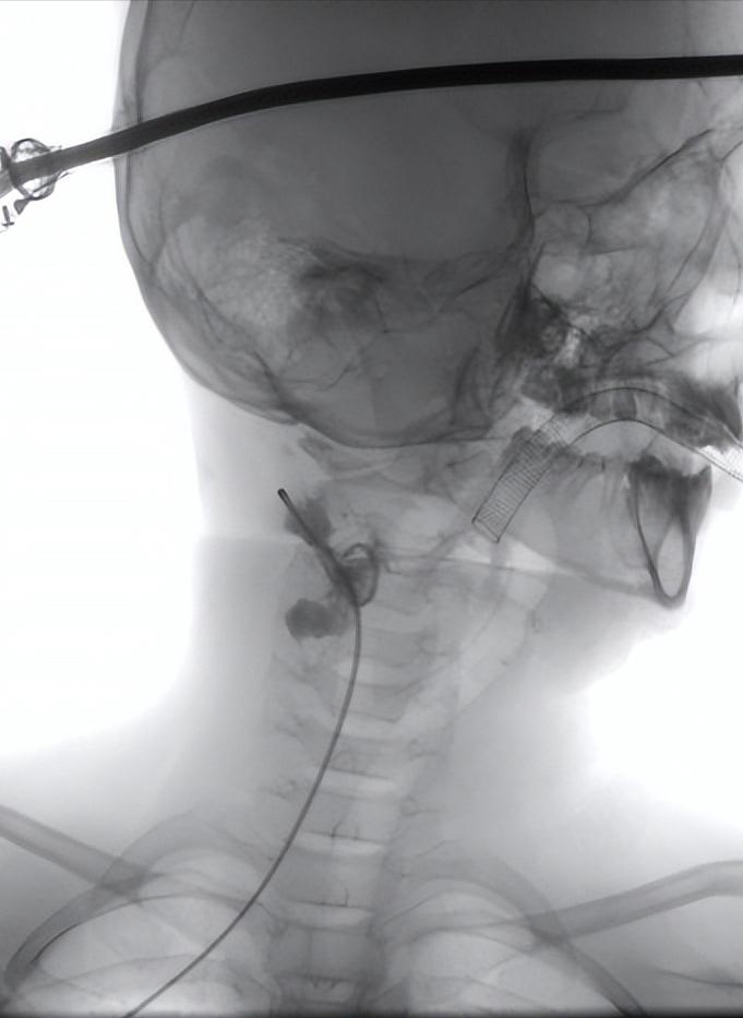 2岁颈部水囊状淋巴管瘤,颈部淋巴管瘤微创介入手术方法