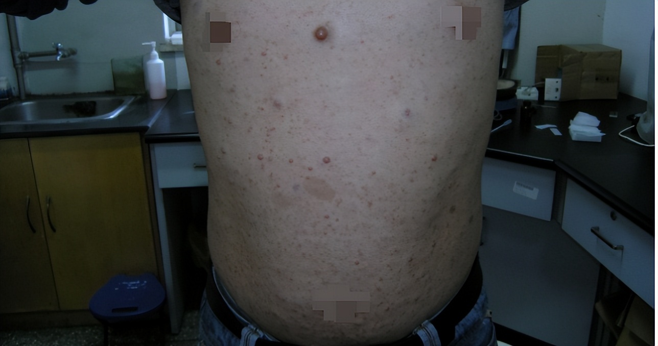 河南22岁女孩体内上千瘤子,22岁女孩体内有1000多个瘤子后续