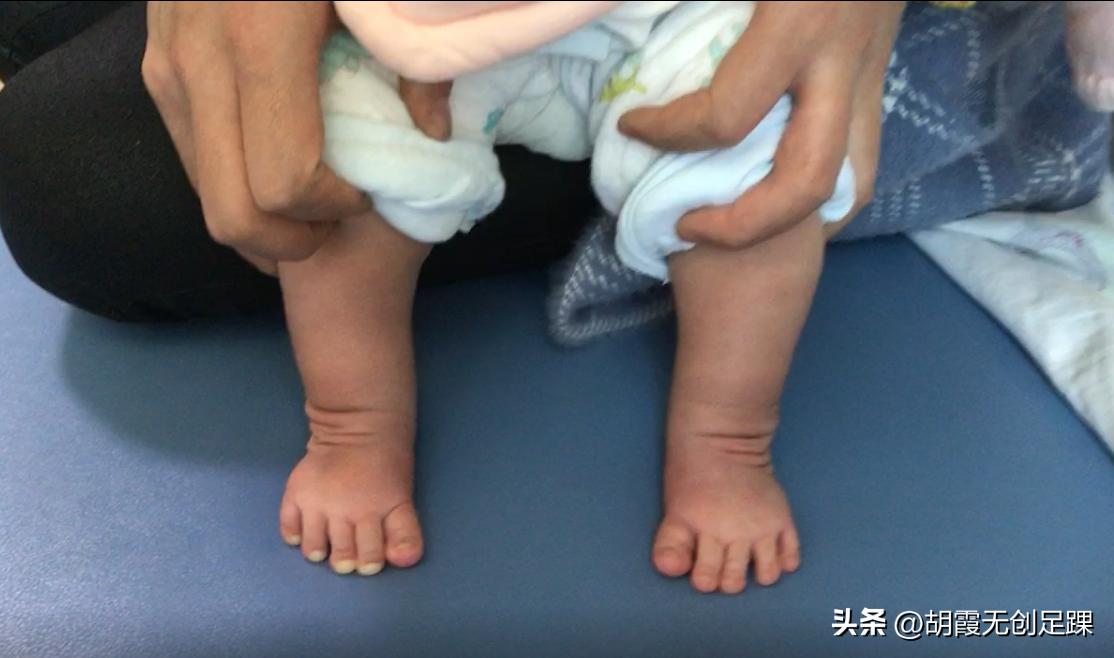 婴儿足内翻手术有后遗症吗,婴儿足内翻矫正多久能治好