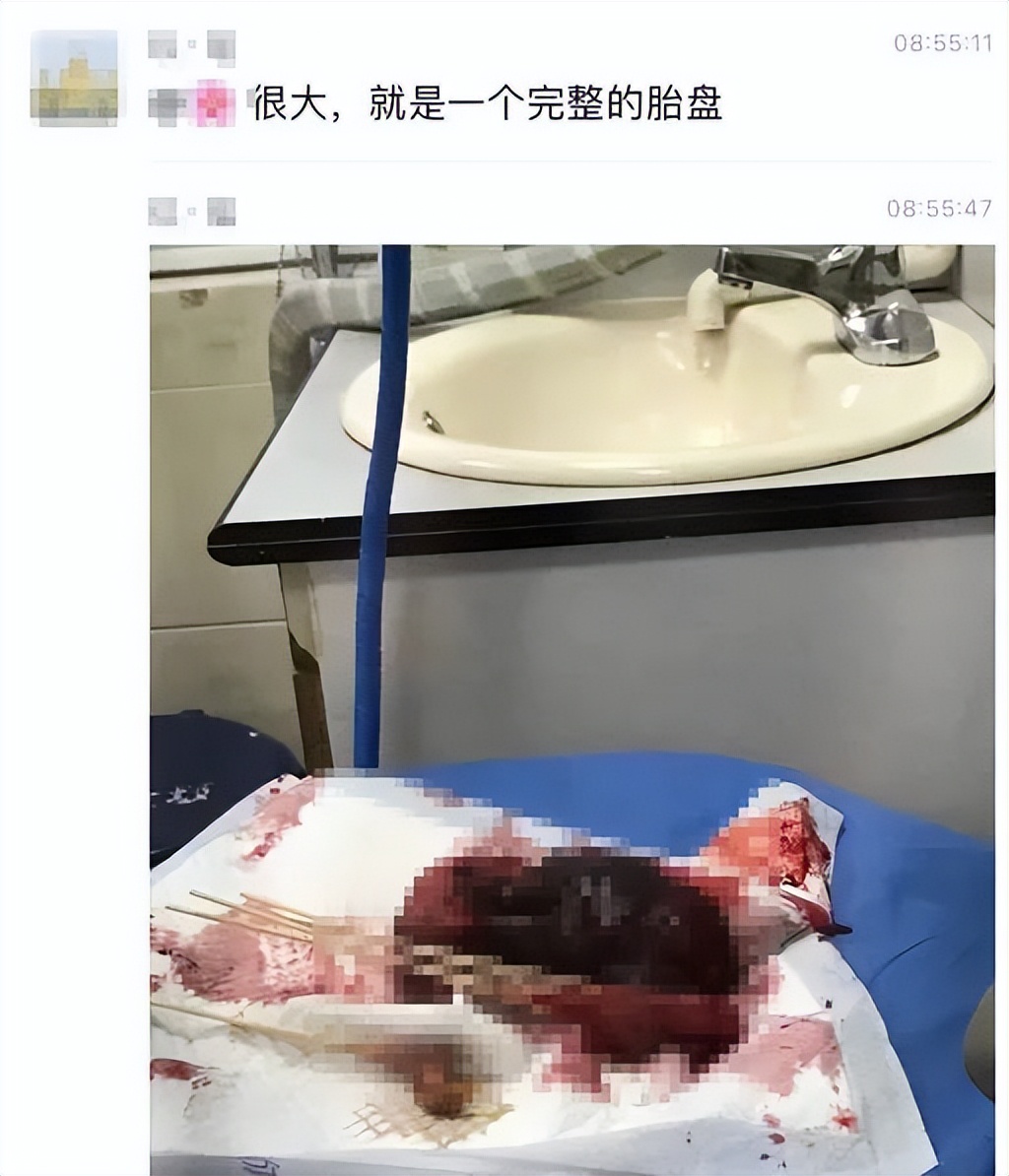 医生把胎盘拿走了,21天胎盘留体内