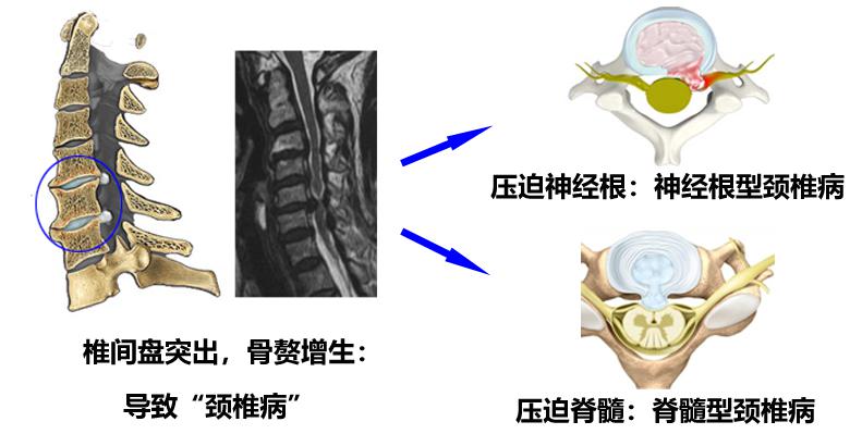 颈椎什么情况可以做微创手术,颈椎什么情况可做微创手术