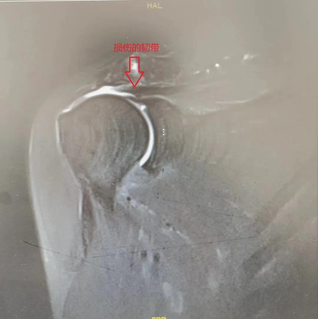 郑大一附院肩袖损伤专家,山大二院哪个专家看肩袖损伤好