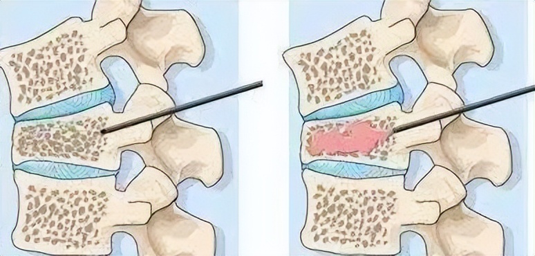 打个喷嚏导致腰椎骨折视频,打个喷嚏全身骨折视频