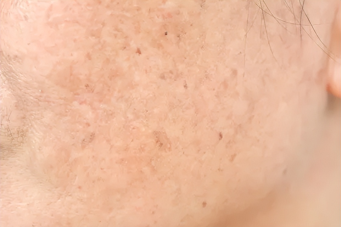 为啥斑点痘印难消,痘印瑕疵怎么办