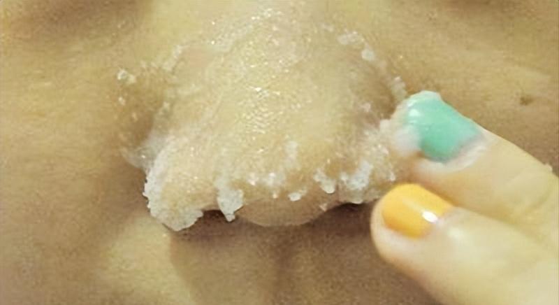 鼻子的黑头跟草莓一样,草莓黑头怎么去除最有效