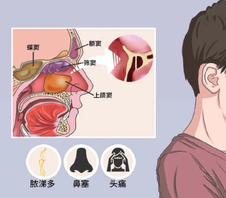 儿童鼻窦炎炎症很高,儿童鼻窦炎百科介绍