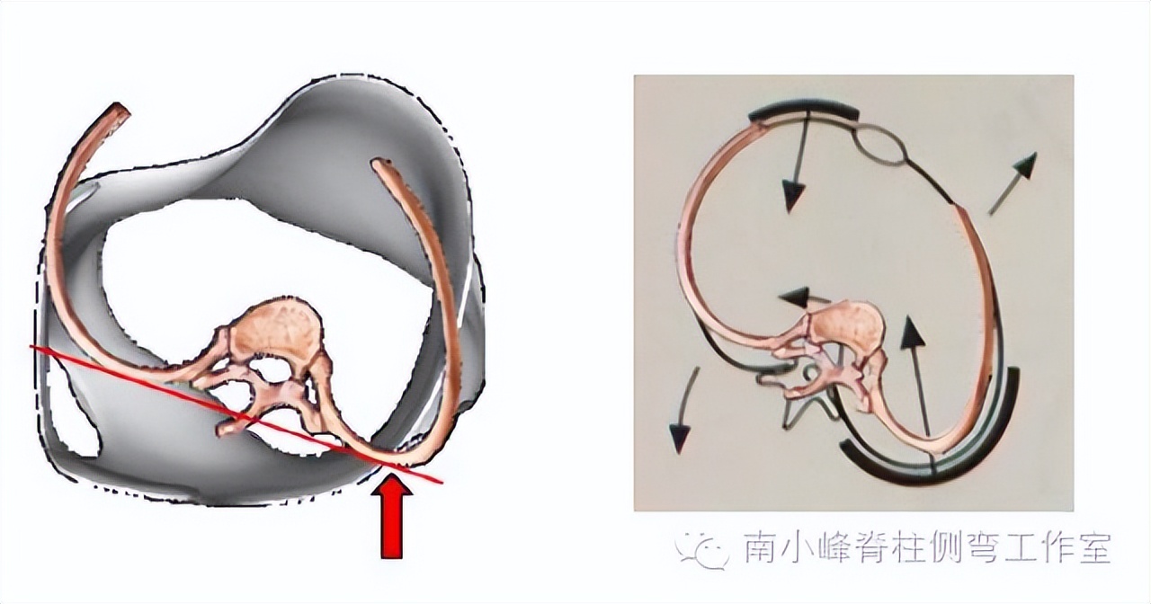 脊柱侧弯出现剃刀背必须手术吗,儿童脊柱侧弯正确的矫正方法