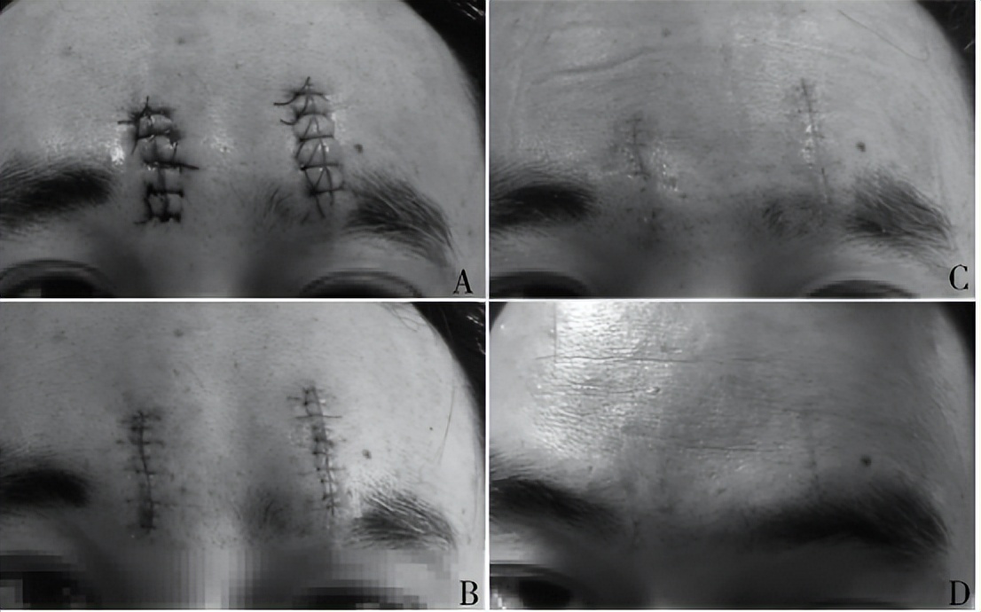 受伤后千万不要抠结痂,受伤了希望不要留下疤痕