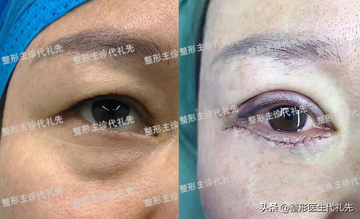 皮肤松弛型的眼袋是不是假性眼袋,眼袋上的小细纹是怎样形成的