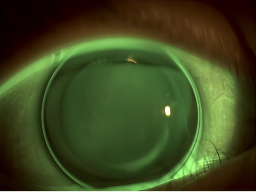 角膜接触镜验配案例图解,戴角膜塑形镜反复出现点染的原因