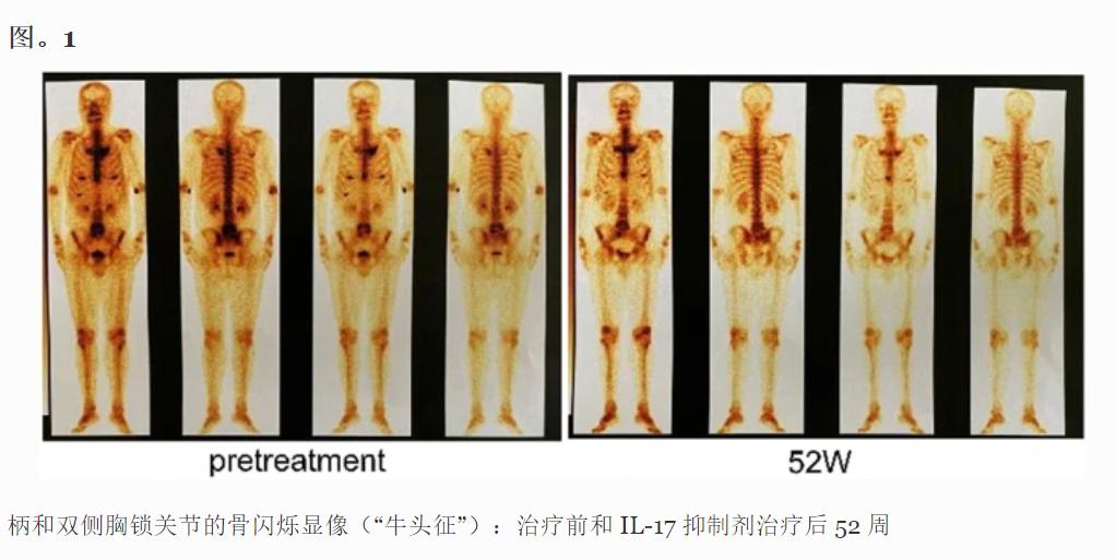 COVID-19疫苗接种后SAPHO综合征并发甲状腺功能异常的病例
