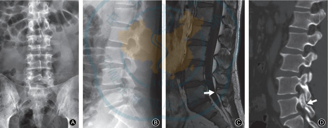 峡部裂和隐性峡部裂有区别吗,单纯峡部裂可以做峡部修复吗