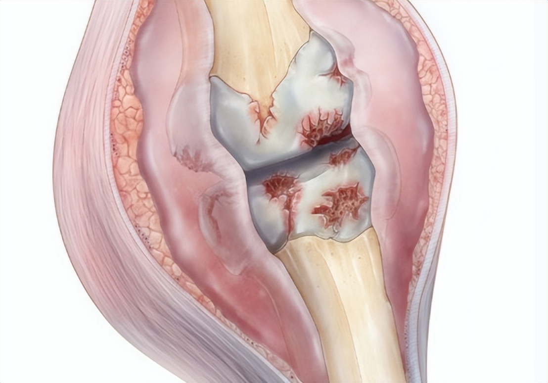 走路膝盖突然软一下吃氨糖行吗,走路时候膝盖突然软一下什么原因