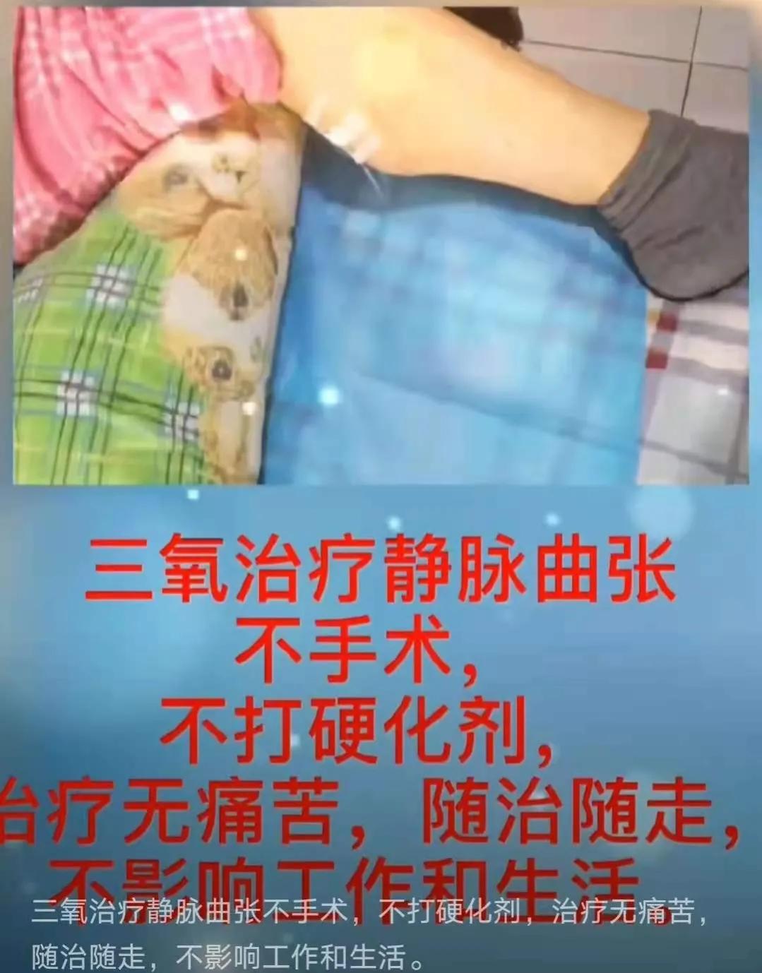 臭氧治疗静脉曲张好不好,臭氧疗法治疗静脉曲张效果怎么样