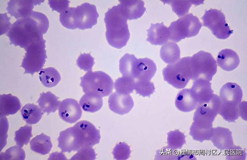 高热健康科普,寒战高热是什么病的表现