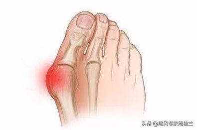 痛风强效药,痛风10种药