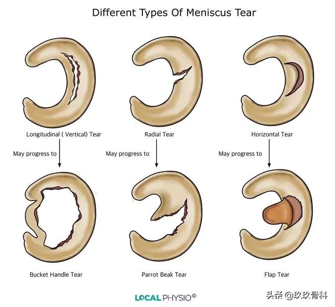 半月板损伤是否需要手术,外侧半月板损伤手术费用
