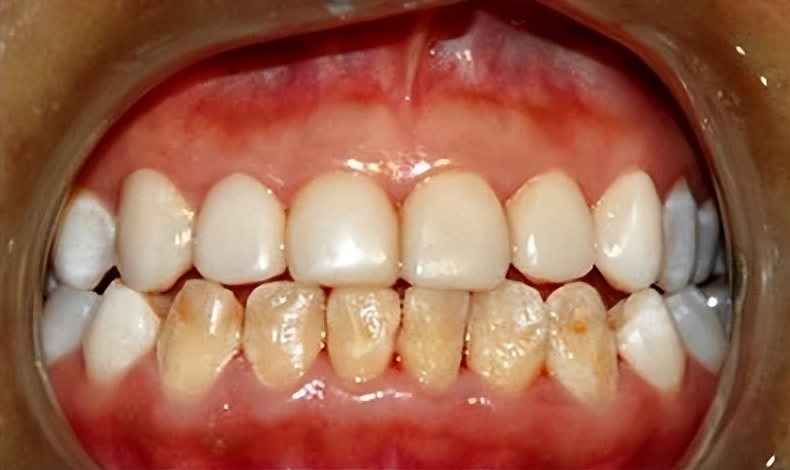 治牙黄口臭教你一招保证牙白,可以让黄牙变白牙的好物推荐