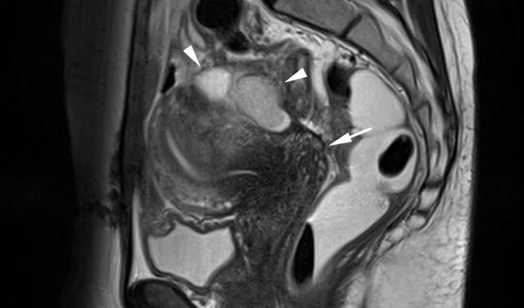 MRI如何评估子宫内膜异位症？这10个病例会帮助您