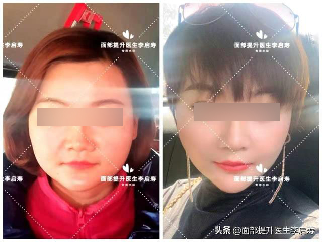 为什么随着年龄脸越来越大,为什么随着年龄的增长脸越来越宽