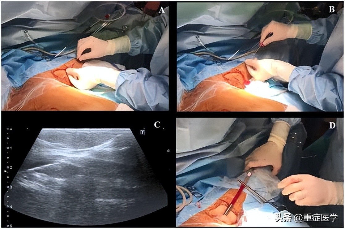 腋静脉穿刺技巧ppt,新生儿腋静脉穿刺技巧视频
