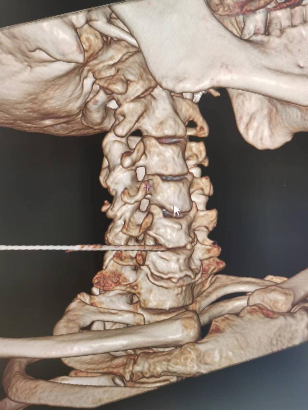 眩晕治不愈,西安中医医院治疗颈椎压迫眩晕
