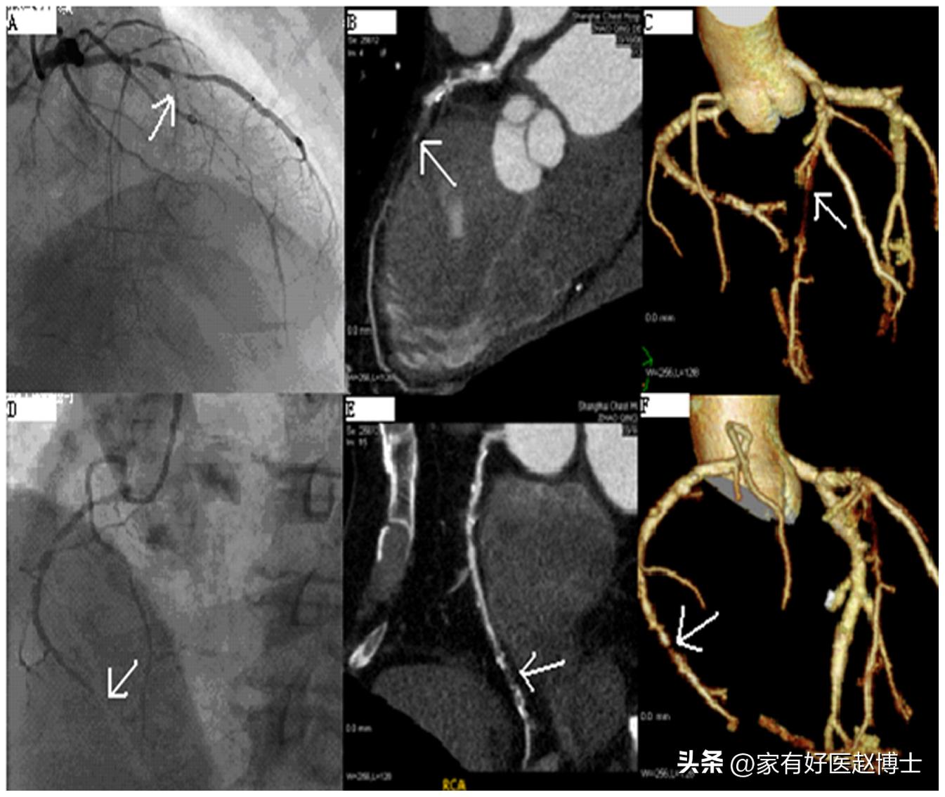 体检提示心血管局部钙化,体检发现冠脉见钙化影是什么意思