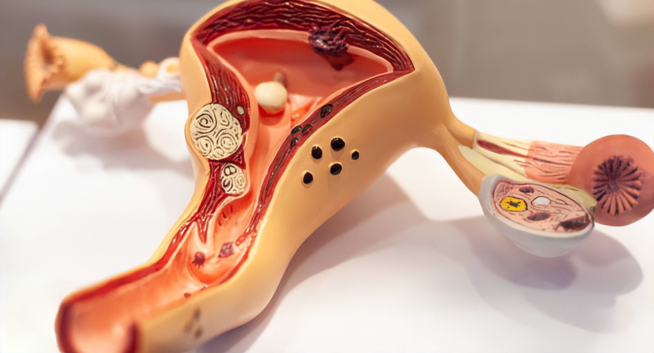 宫颈不典型增生是什么？是宫颈癌的前兆吗？预防办法来了！