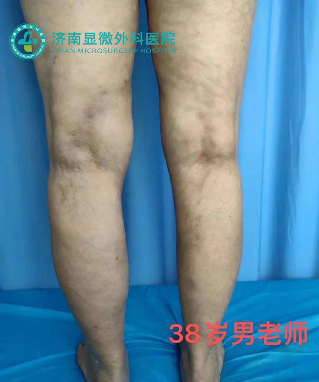 微创治疗静脉曲张是小手术吗,微创手术治疗静脉曲张效果怎么样