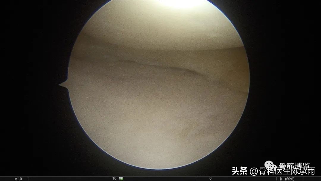 盘状半月板撕裂一级,半月板层裂愈合概率