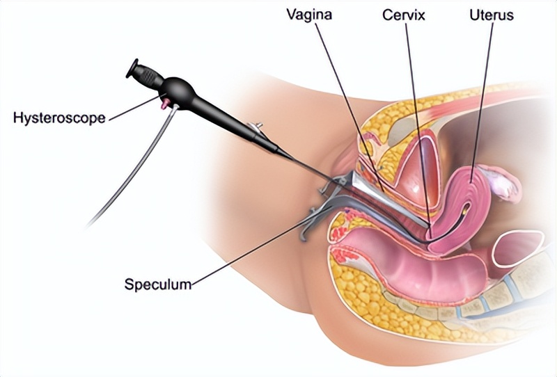 派特灵治妇科,派特灵生物讲解