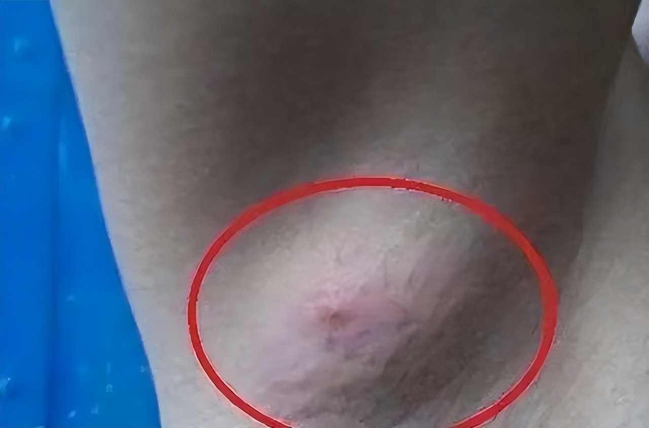 腋下有肿块是不是艾滋病,腋下有肿块是艾滋病的表现吗