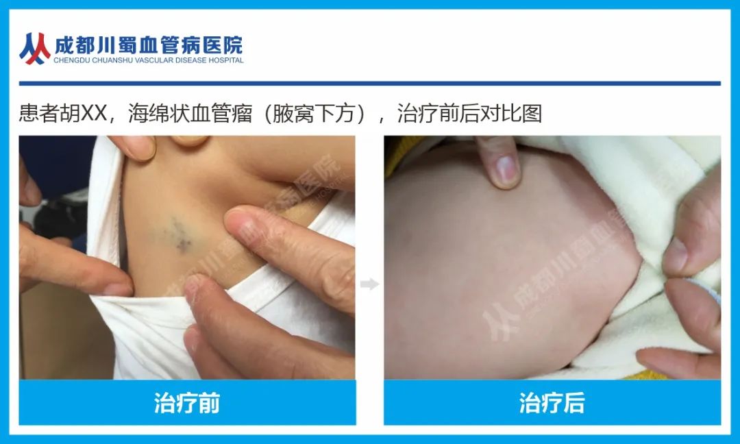 小红斑，*麻大**烦！警惕血管瘤健康隐患