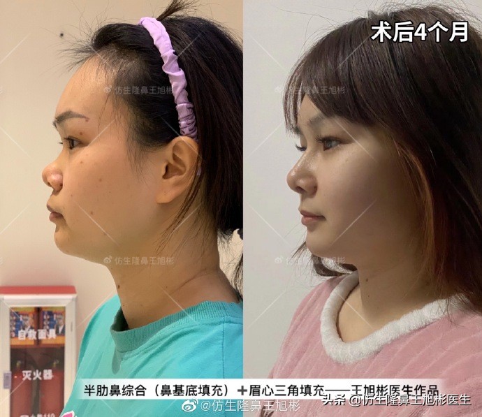 常见鼻部整形美容项目,整形鼻和自然鼻