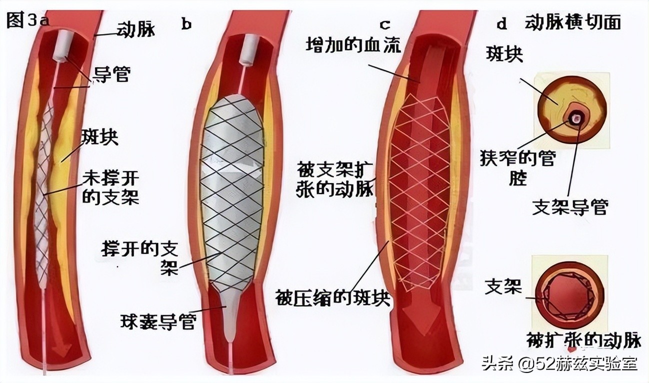 从13000元骤降至700元！看国产心脏支架如何吊打国外？