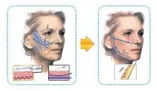 悬吊提升和线雕哪个好,线雕提升的作用与副作用