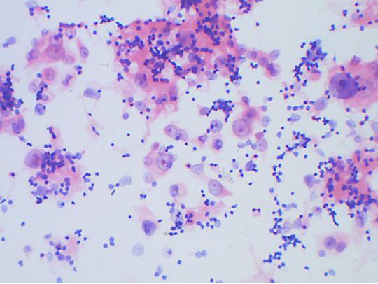 HPV感染和宫颈癌的预防与早期发现