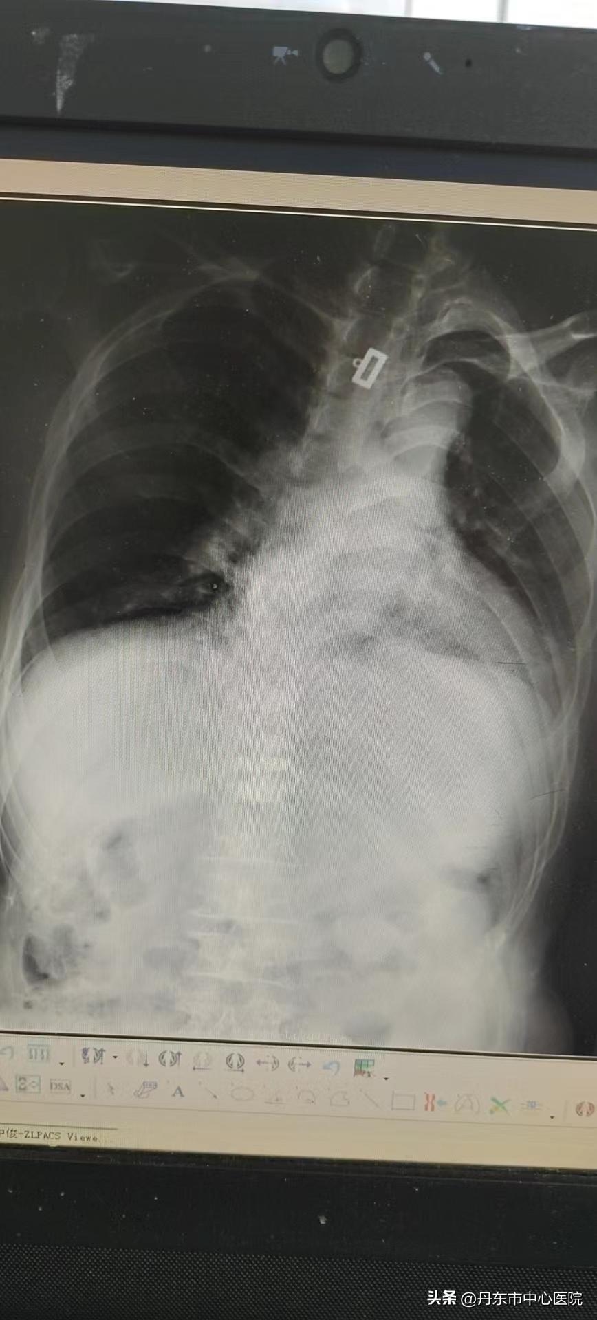 微创椎间盘成形术,经皮椎间盘成形术