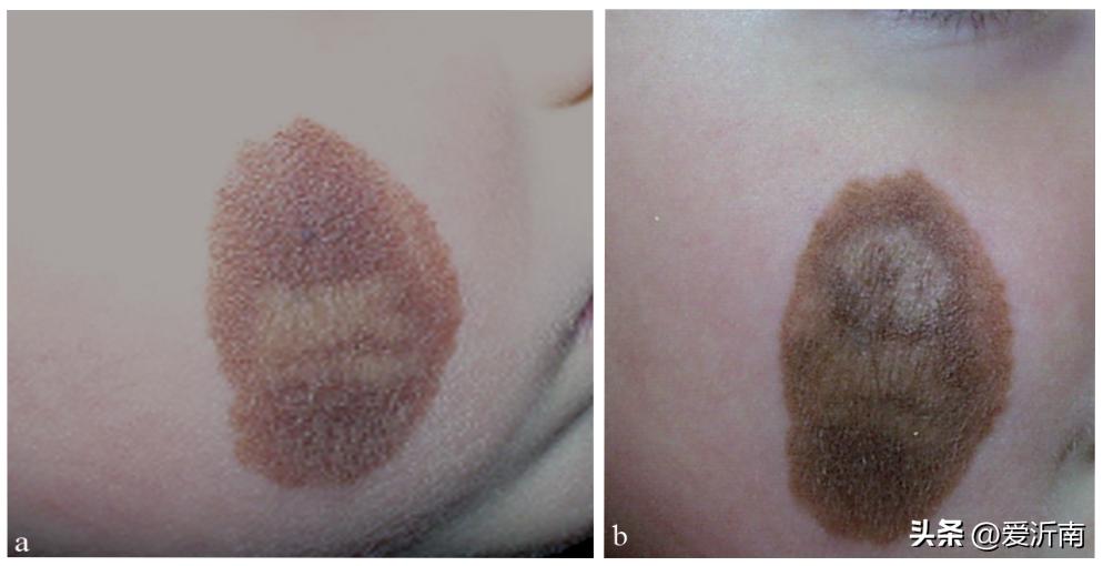 背上长了个肉痣是癌的象征吗,痣越多越容易得癌症