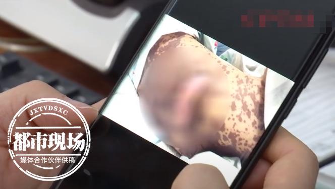 青少年身上有刺痛感像针扎,皮肤针扎般疼痛怎么治