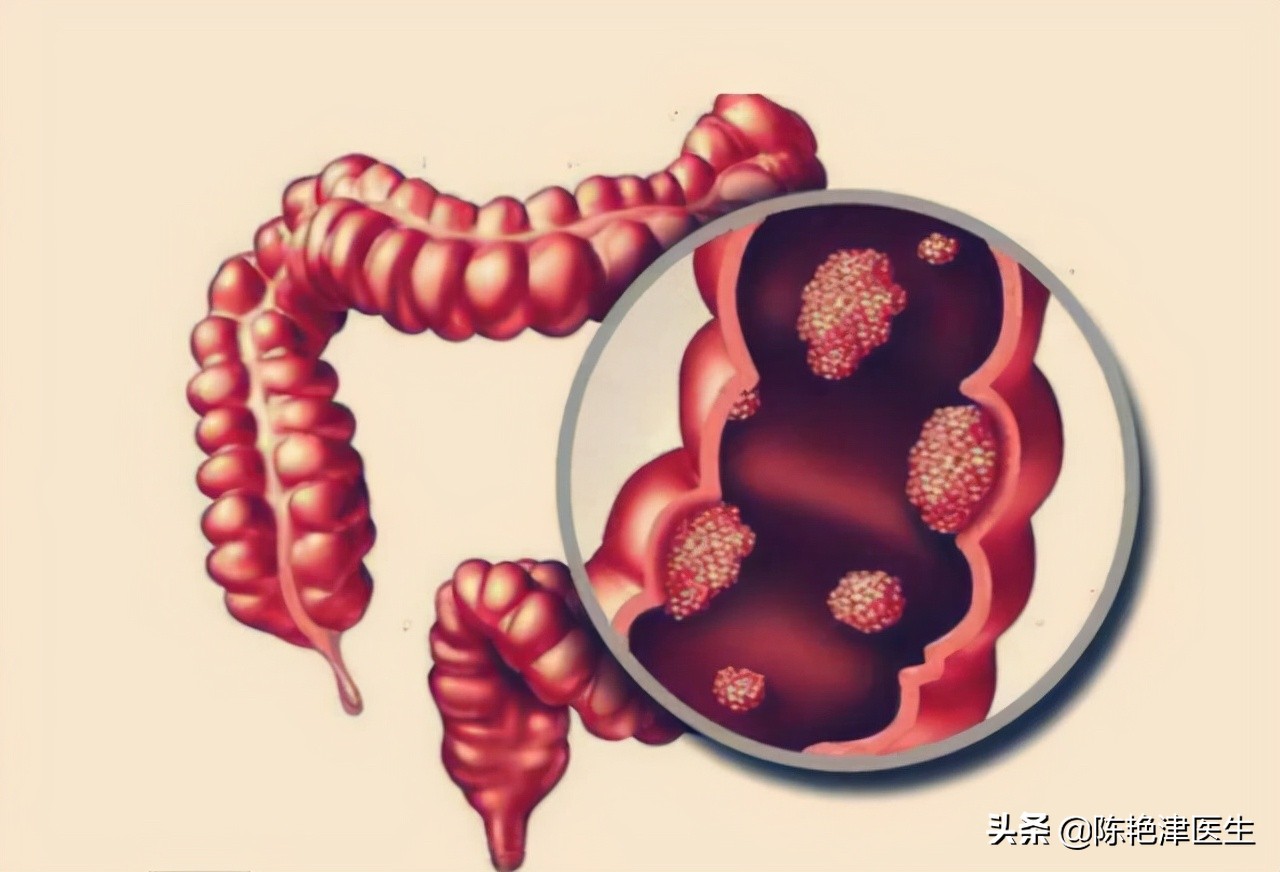 肠息肉是肠癌最大的祸根,肠息肉有癌变风险中医怎么预防
