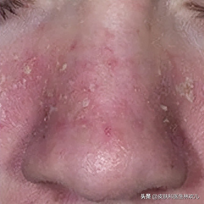 鼻翼两边泛红起皮抹芦荟胶有用吗,鼻翼两侧泛红起皮黄色结痂