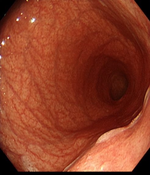 掌健识健康百科,国际护胃日略谈慢性胃炎