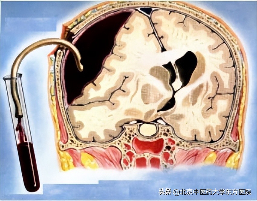 老年人慢性硬膜下血肿,老年性慢性硬膜下血肿的注意事项