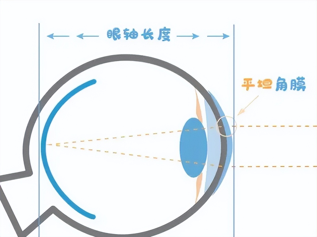 10岁孩子眼轴正常一年长多少,孩子的眼轴能恢复正常吗