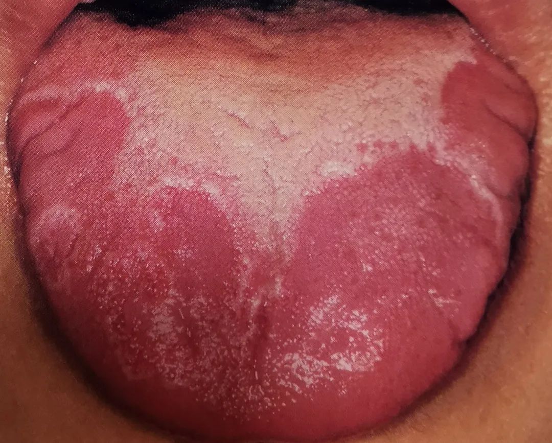 宝宝经常地图舌头怎么回事,宝宝反反复复地图舌