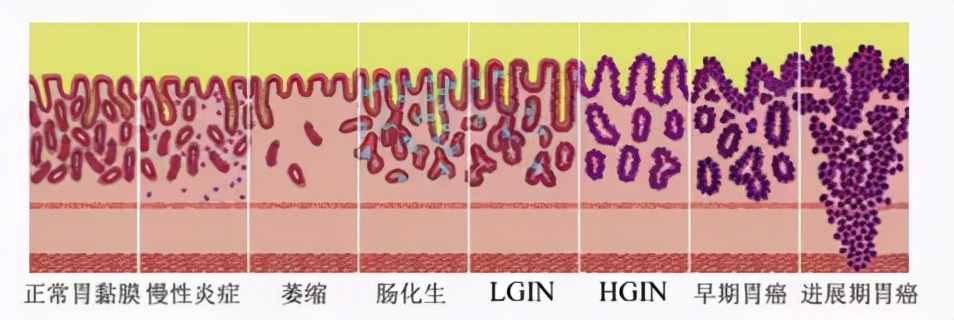 胃粘膜肠上皮化生癌变几率,肠上皮化生到癌变概率