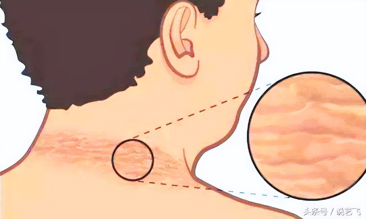 脖子后面黑洗不掉是什么原因,脖子后面黑黑的是黑棘皮症吗